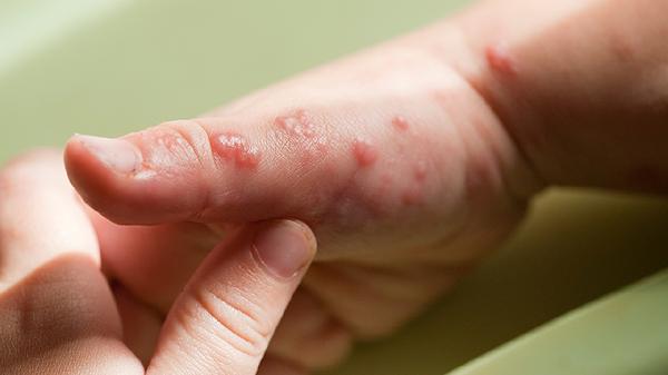 疱疹性结膜炎会引起尿潜血吗