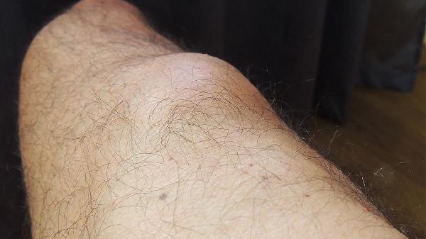 皮下纖維瘤的形成原因