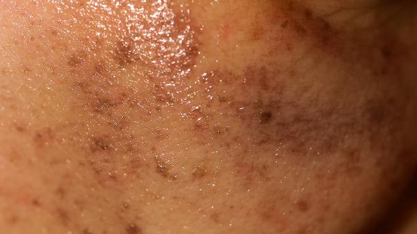 暴曬了皮膚刺疼怎么補救