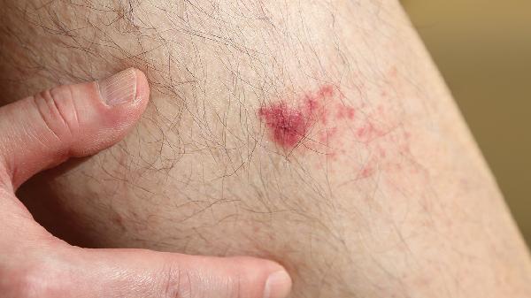 怎么判斷皮膚是否松弛