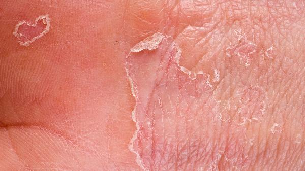 皮膚黃色硬塊有點(diǎn)疼痛