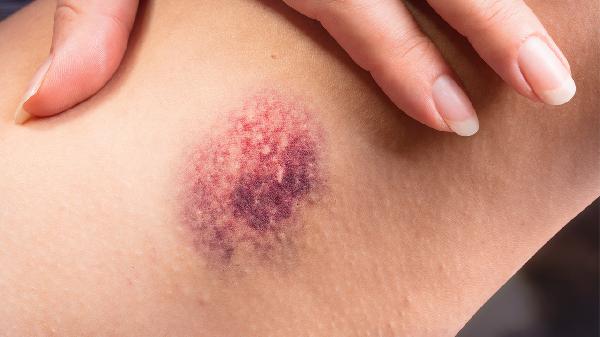 肺膿腫有空洞多久可以治療好呢