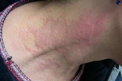 膽堿能性蕁麻疹的和癥狀