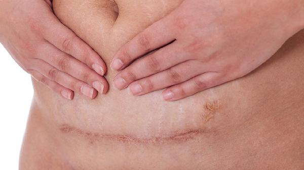 剖腹產(chǎn)右邊肚子硬塊要警惕