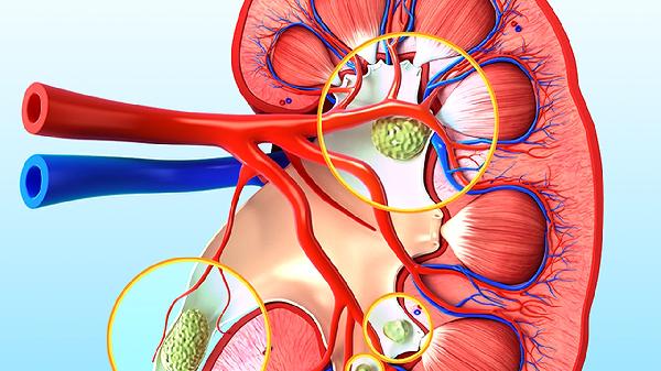 腎囊腫和腎盂囊腫一樣嗎嚴(yán)重嗎