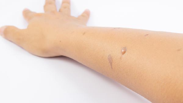 三伏贴后起了大水泡说明什么体质