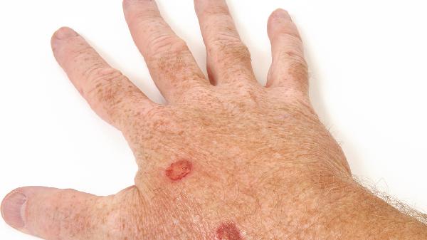 脚上长水泡脱皮是什么原因