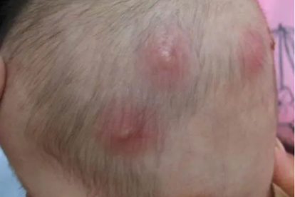 嘴角毛囊炎是怎么回事