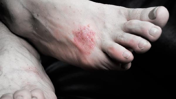 頭部銀屑病可以治愈嗎