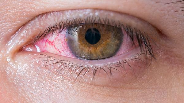 辣椒碰了眼睛怎么辦