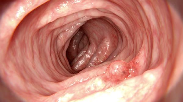 尿管镜检查是怎么回事