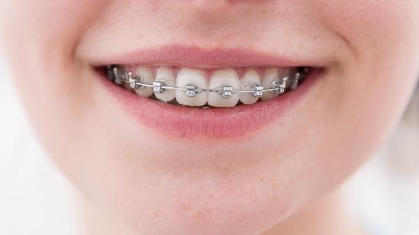 深覆合要怎么矯正