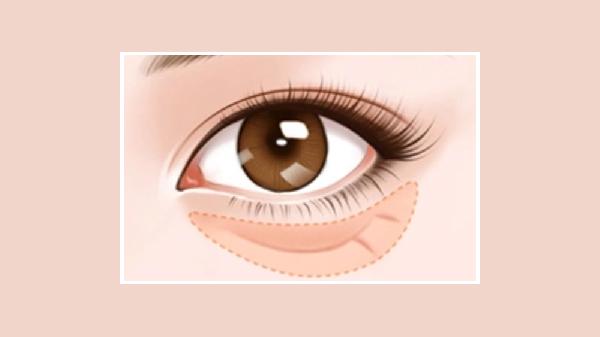 祛除眼袋手術(shù)有哪些