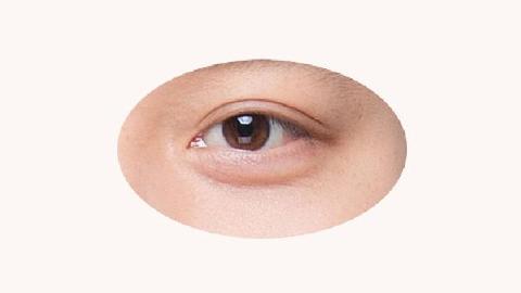 双眼皮的适应人群有哪些