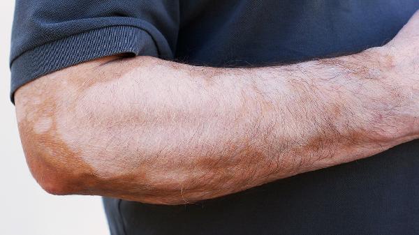 白癜風(fēng)治療的方法有哪些的啊