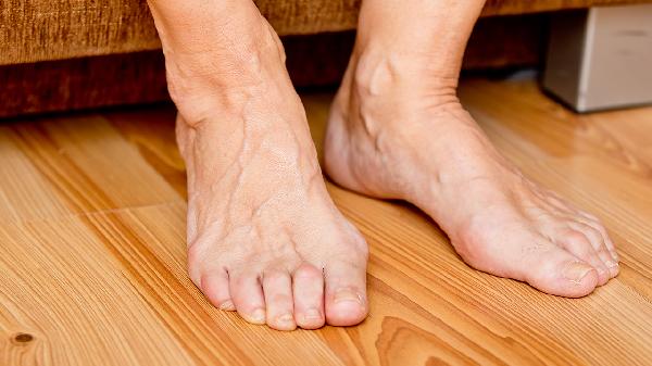 精索靜脈曲張影響夫妻生活嗎