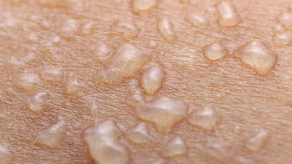 燙傷傷口為什么會(huì)流血