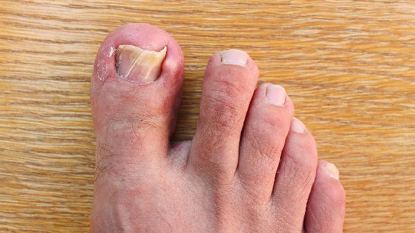 腳指甲長到肉里該怎么處理