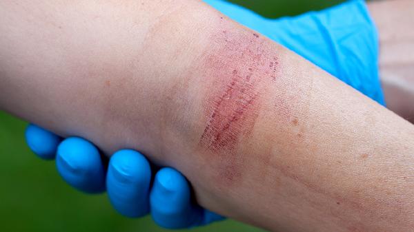 小腿燙傷不聽(tīng)抽筋怎么辦？