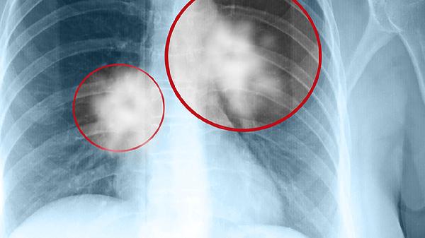 室管膜腫瘤的預(yù)防方法有哪些