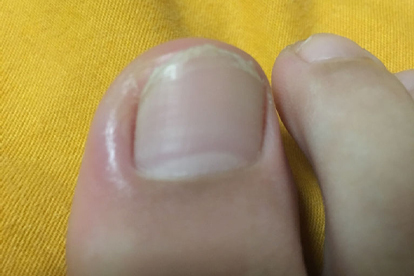 大腳趾甲溝炎怎么辦