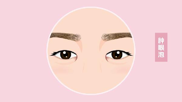 做手術(shù)消除腫眼泡術(shù)后效果