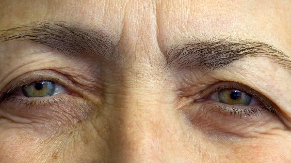 眼部皺紋打玻尿酸行嗎