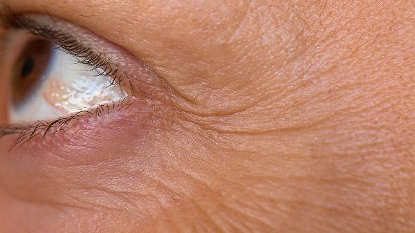怎樣去眼角的皺紋