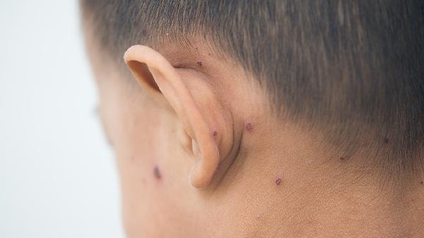 婴儿的鲜红斑痣长大后会自己退掉吗