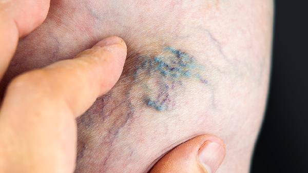 上楼梯膝盖疼是怎么回事