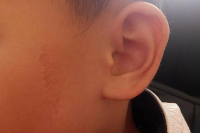 單側(cè)耳朵悶悶的堵住的感覺