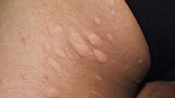 大拇指上有水泡怎么處理