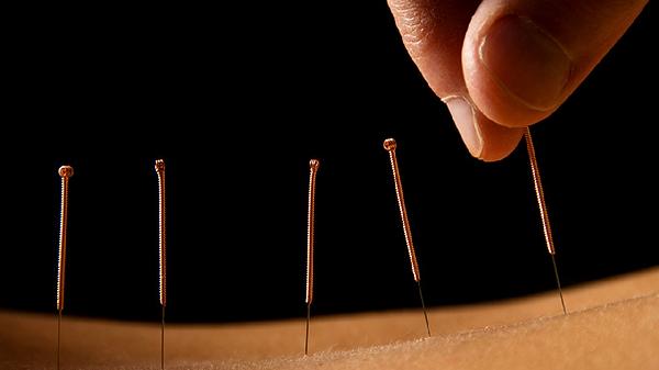 扎針灸的好處和壞處需中藥調(diào)理