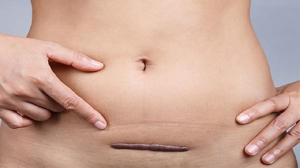 同位素治療疤痕疙瘩掛什么科