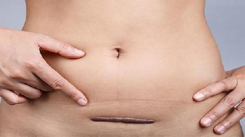 同位素治疗疤痕疙瘩挂什么科