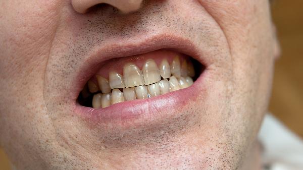 牙鎖合嚴重有什么后果