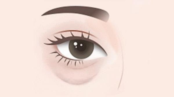 眶隔脂肪釋放術(shù)效果好嗎