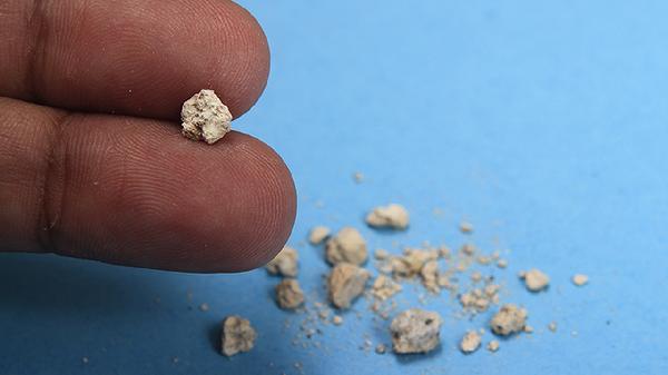 雙腎多發(fā)性結(jié)石怎么消除