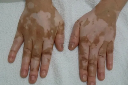 中醫(yī)治療白癜風(fēng)的效果好嗎