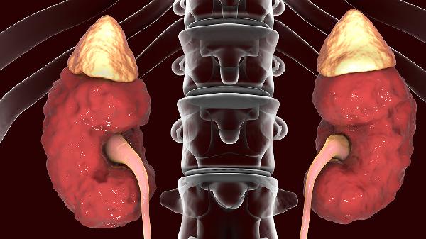 腎病綜合征水腫吃什么好得快些