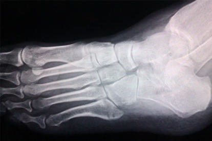 腳骨裂了怎么恢復最快