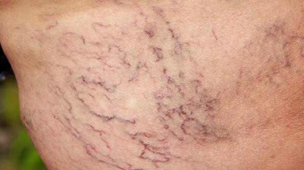 大腿又粗又结实怎么减