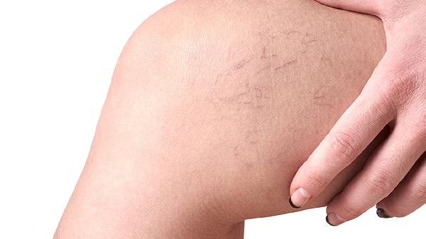 膝蓋上部疼痛是什么原因