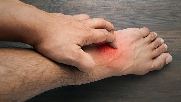 花斑癬是什么樣子的