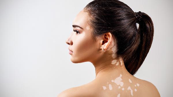 什么中藥制劑治療白癜風(fēng)