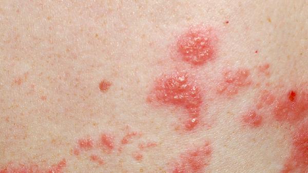 皮膚干燥癥早期癥狀是什么