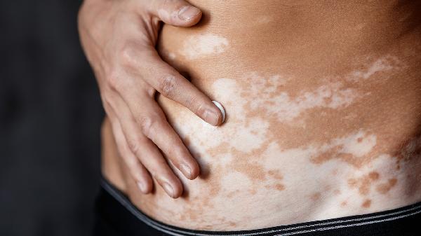 白癜風(fēng)和花斑癬的區(qū)別