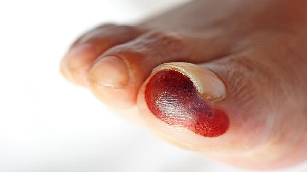 做脫手腳毛術(shù)后效果