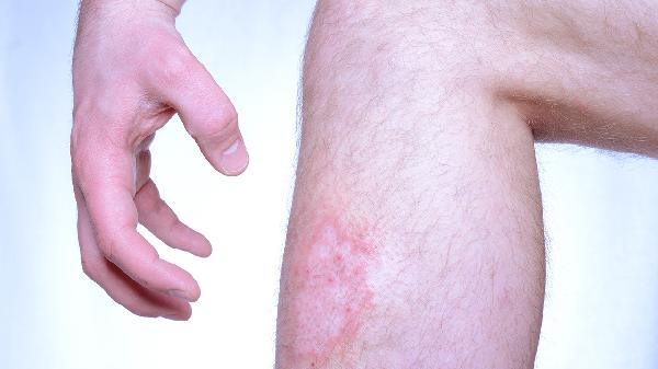 副銀屑病外用什么藥膏