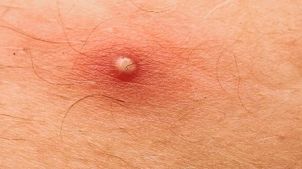 皮膚代謝功能失常怎樣調(diào)理